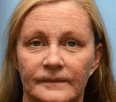 Awzlove™ Crema Anti-Arrugas con Botox y Veneno de Abeja | Aprobado por COFEPRIS 🌲